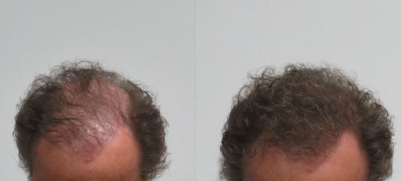 Boev hairfibers voor en na kale plek bedekken haarvezels kaalheid voorkant
