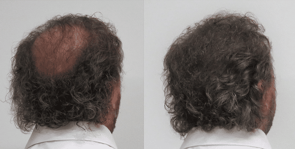 Boev hairfibers voor en na kale plek bedekken haarvezels kaalheid achterkant